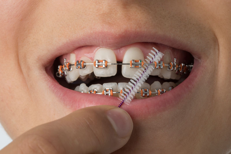 Cómo cuidar tus dientes con brackets